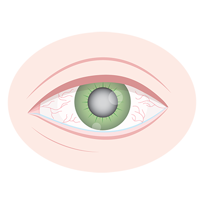 Eye Glaucoma