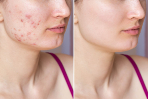 The ultimate skincare routine for acne-prone skin