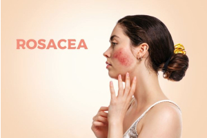 Rosacea: Causes, symptoms and treatment