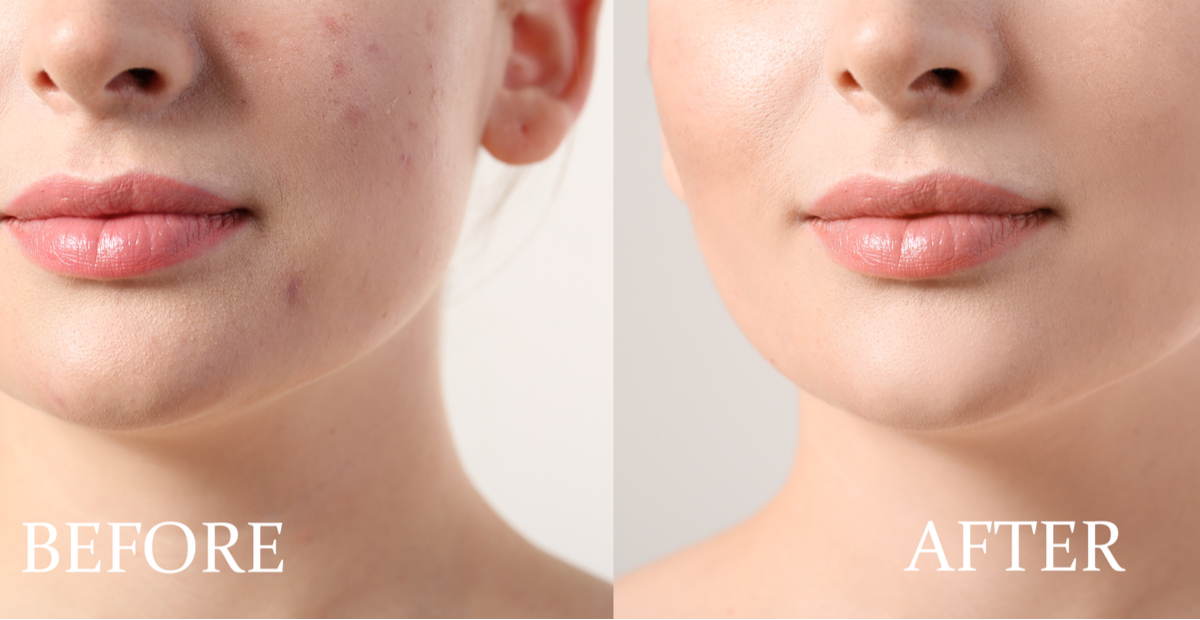 4 Stages of Acne and its Treatment