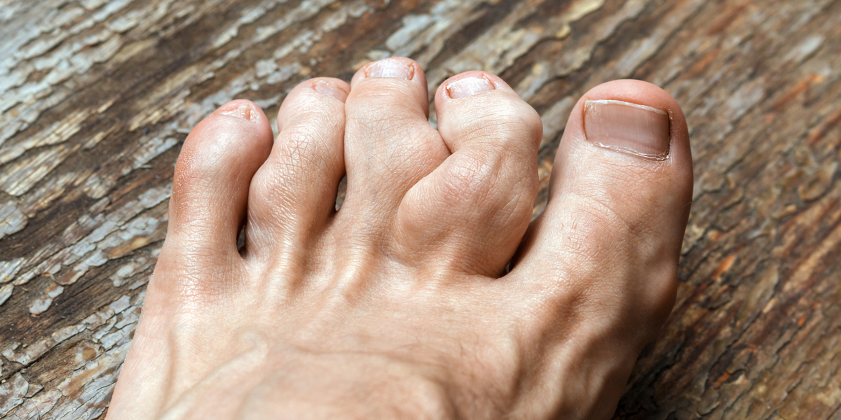4 Ways to Deal with a Painful Gout Attack