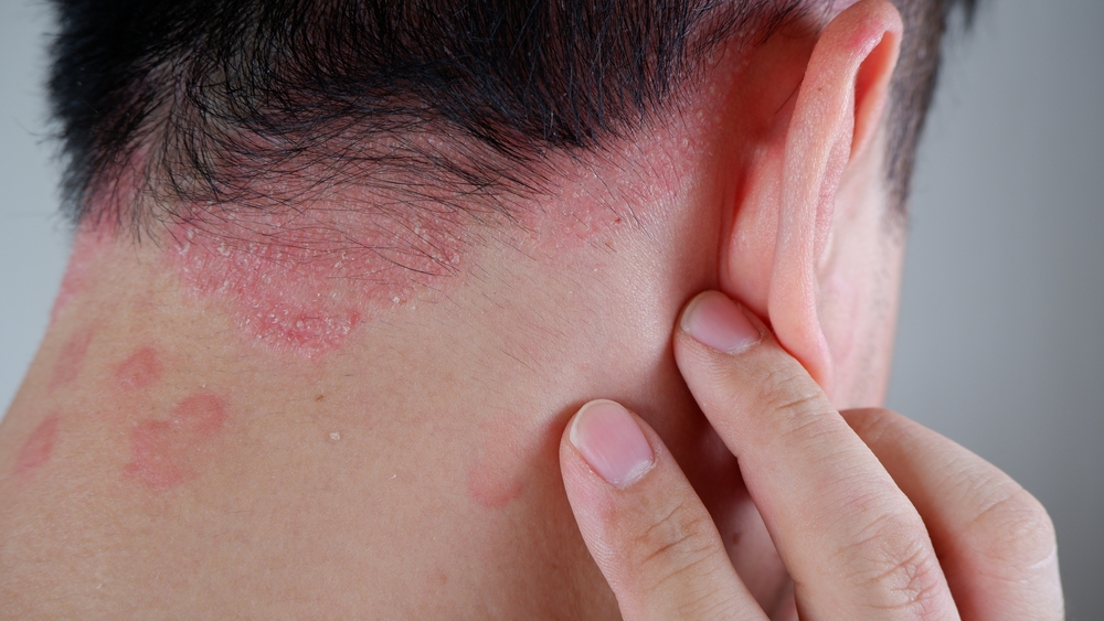 Discover 5 crucial facts about psoriasis 