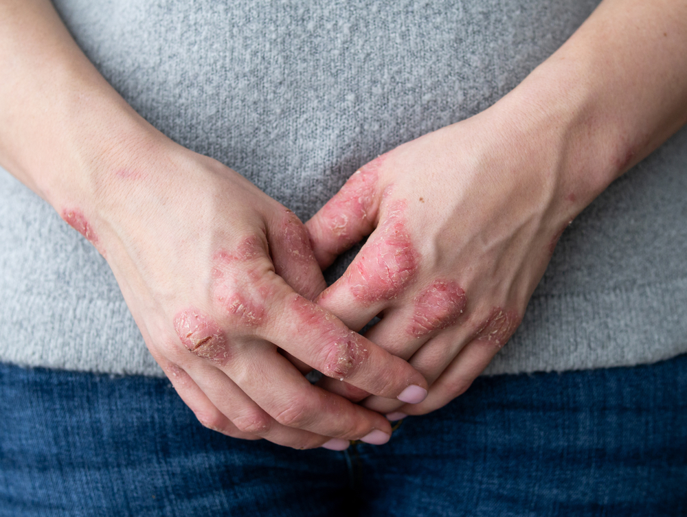 A New Psoriasis Flare-Up After Pregnancy