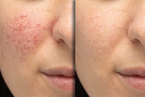 Acne or Rosacea: what's the difference?