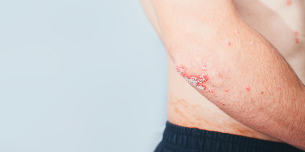 Causes of Psoriasis and Treatment 