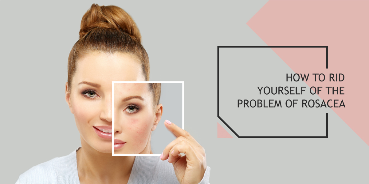 How to rid yourself of the problem of Rosacea