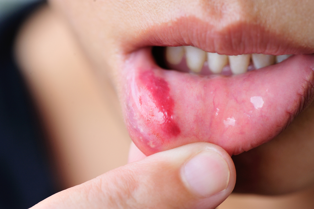 Oral thrush: Are you Familiar with the Symptoms and Causes