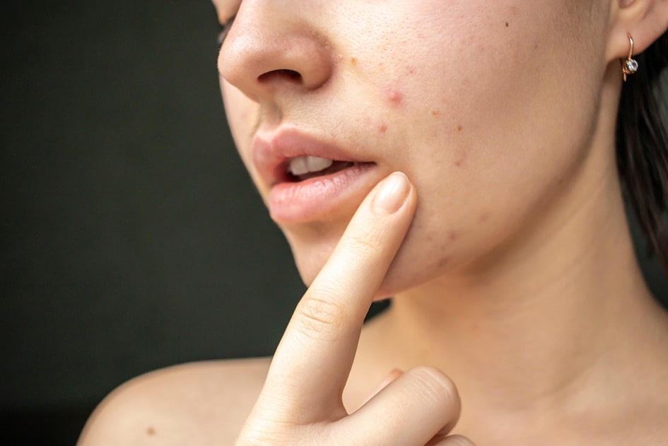 Understanding effective treatment options for adult-onset acne