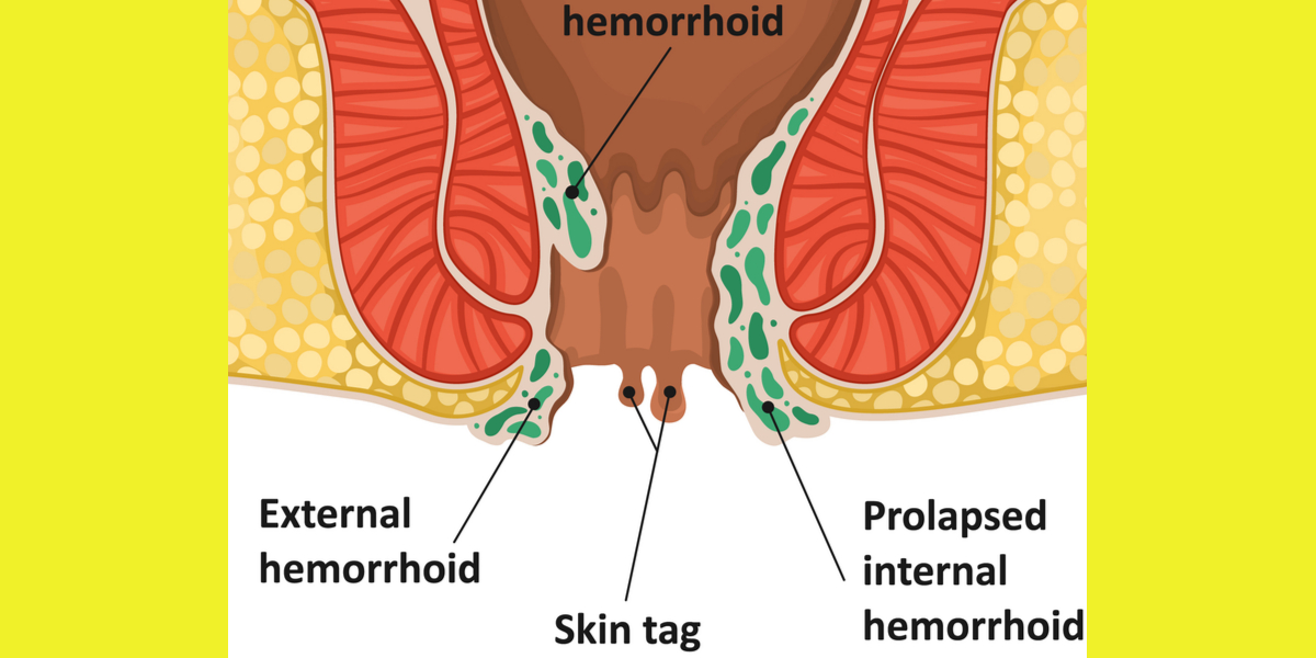 The Difference Between a Hemorrhoids and Skin Tag