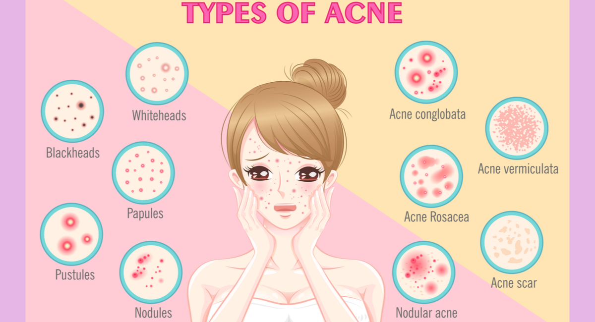 Types of acne problems and how they affect the skin