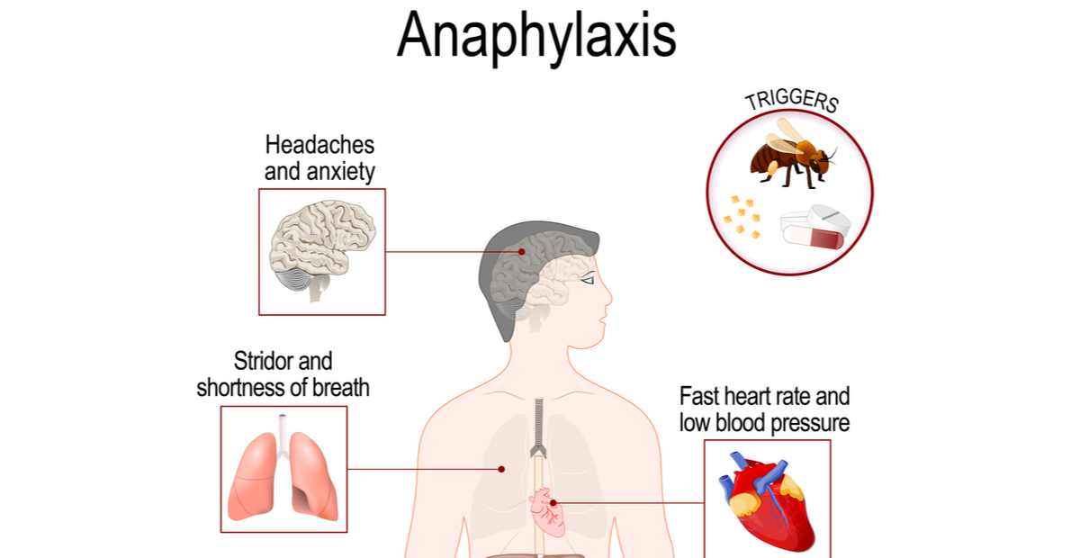 What is Anaphylaxis? Signs, Symptoms and Dangers