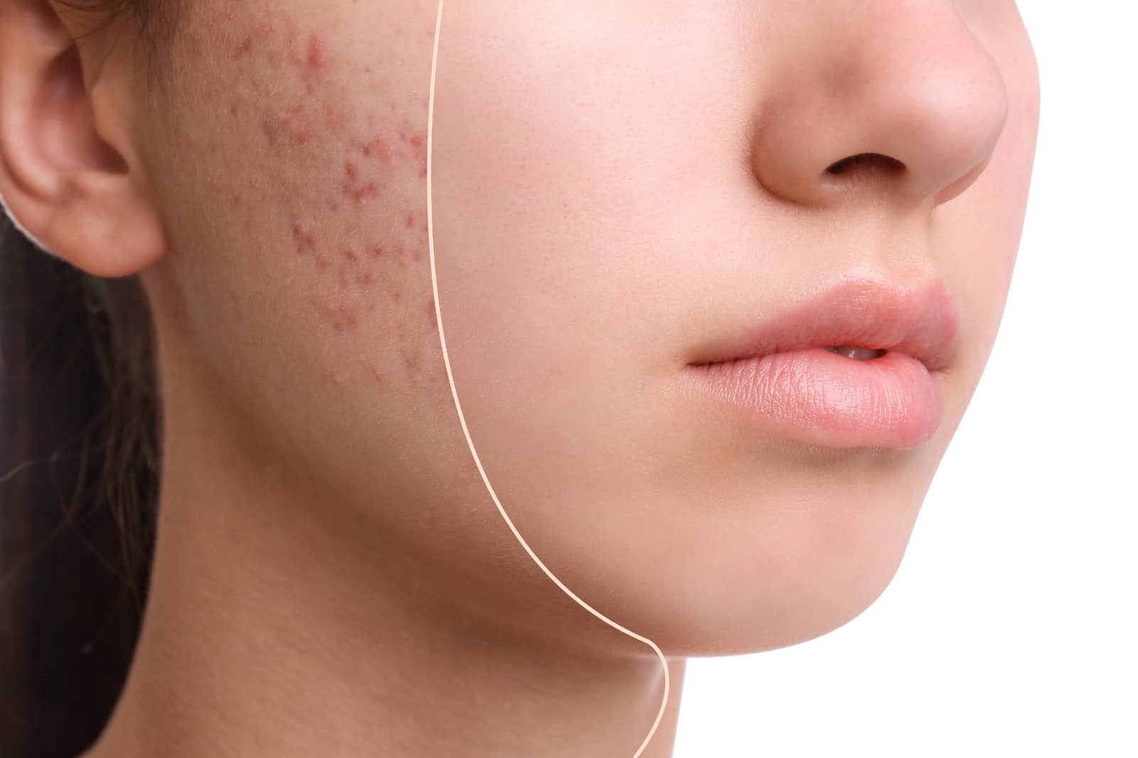 Breaking down the best treatment options for stubborn acne scars