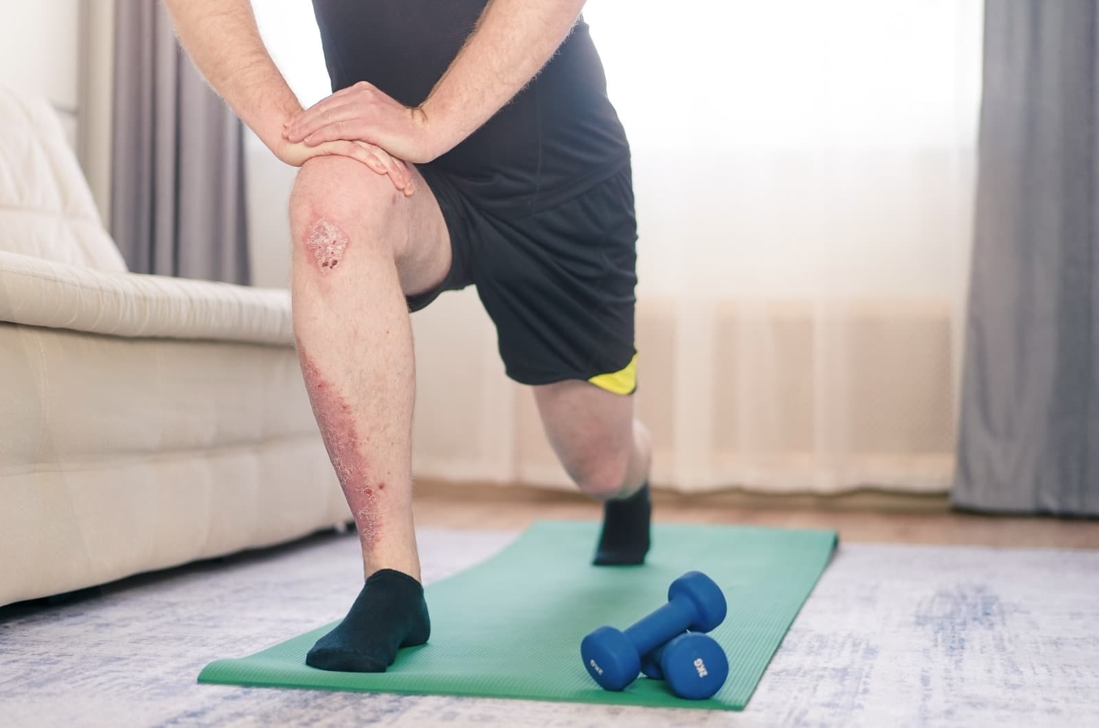 The benefits of exercise for psoriasis