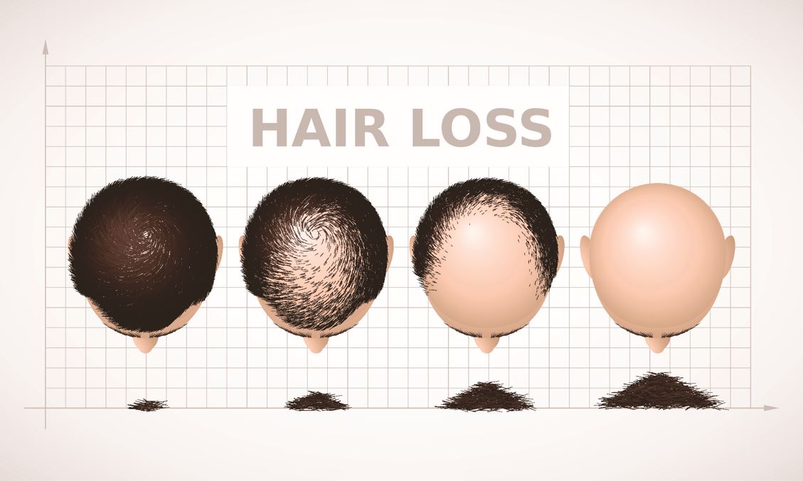 Navigating the stages of hair loss in men
