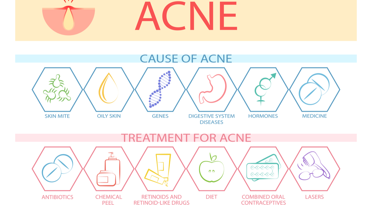 Acne: Understanding the Cause and Treatment