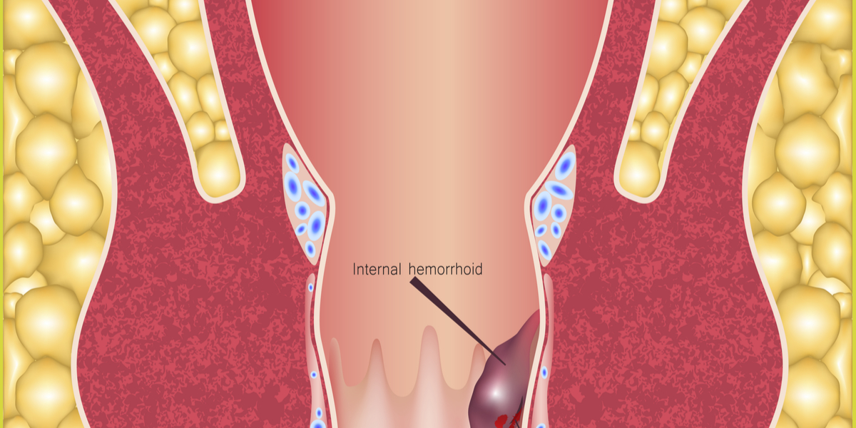 Can Kidney Problems Cause Hemorrhoids?
