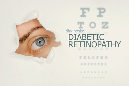 The 4 Stages of Diabetic Retinopathy