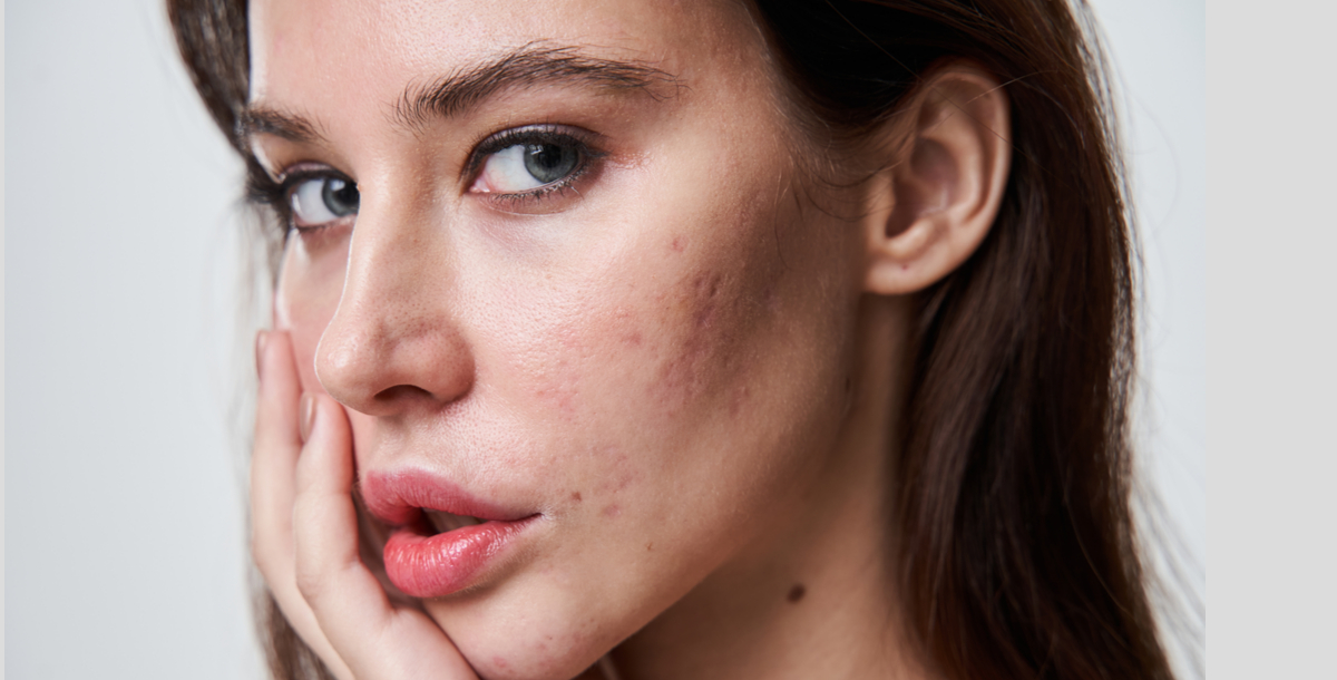 How to Distinguish Between Different Types of Acne

