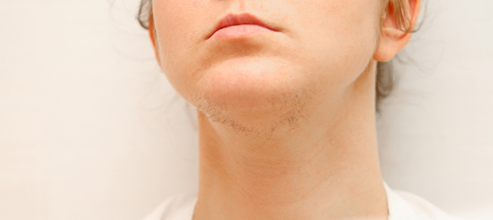 PCOS Facial Hair: Why it Happens and How to Deal With It?