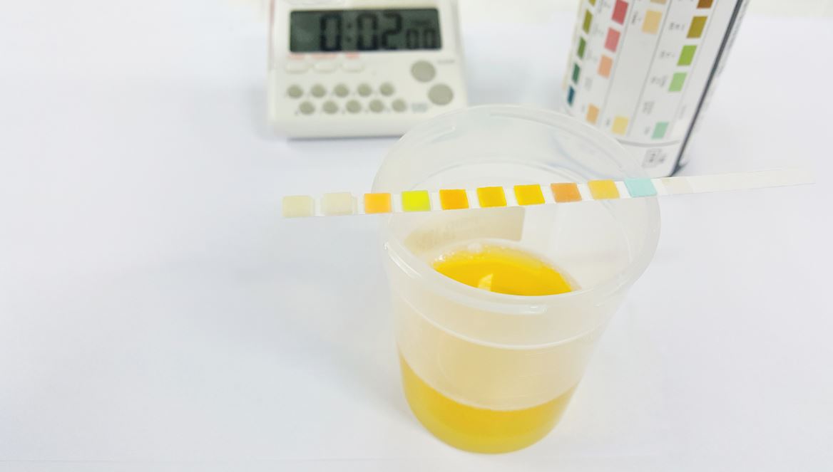 Urine Colour What It Says About Your Health