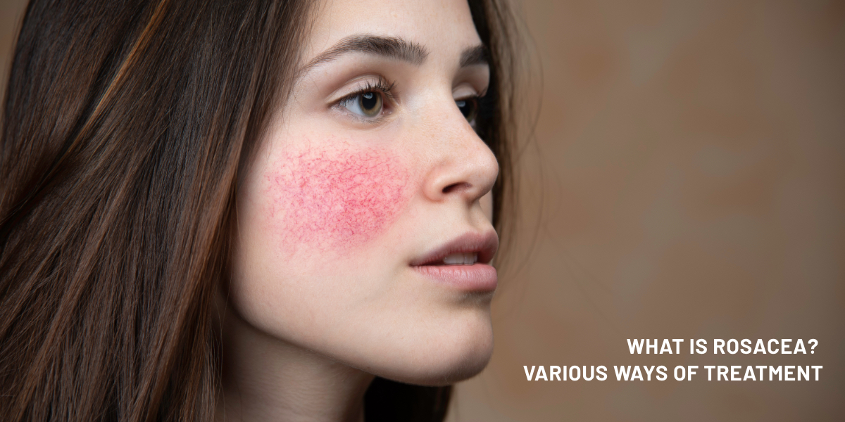 What is Rosacea? Various ways of treatment