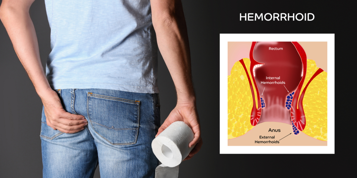 What’s the Difference Between External and Internal Hemorrhoids? 