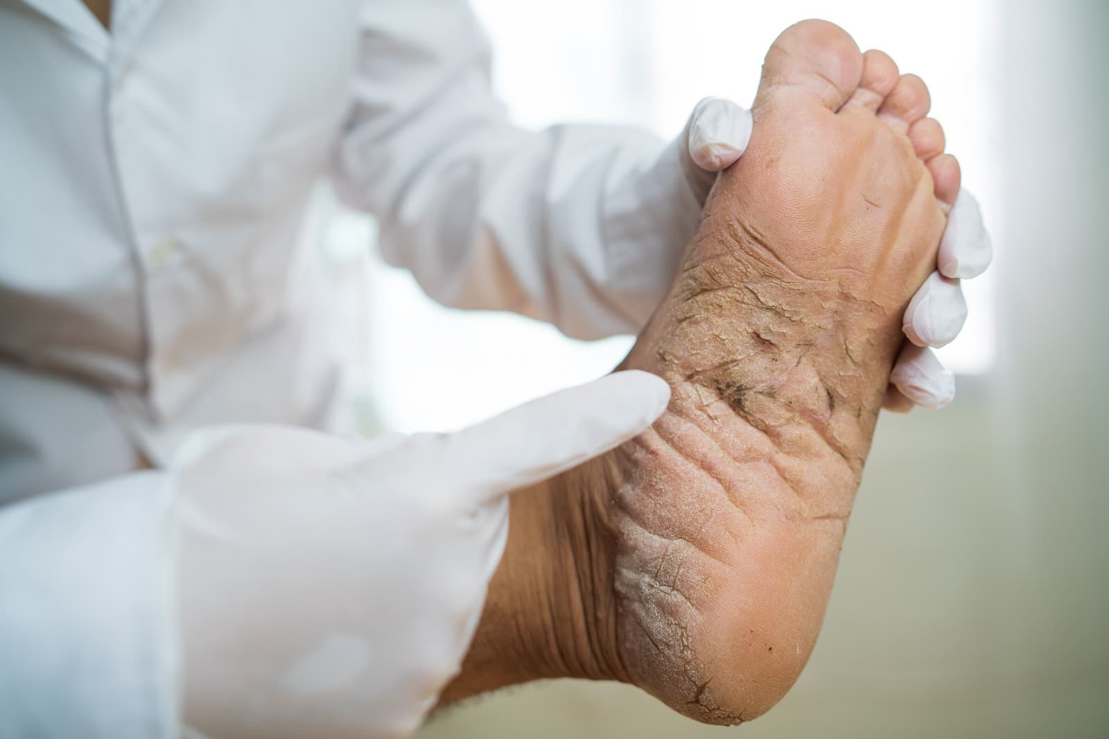 Essential foot care tips for people with diabetes