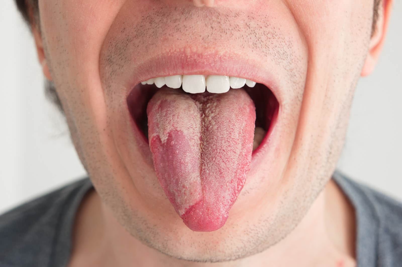 Top oral hygiene methods to prevent thrush
